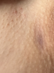 Painful lump in groin area