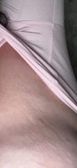 Breast dimpling or stretch marks???