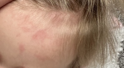 Has anyone else's 1 year old had severe rash after jabs?