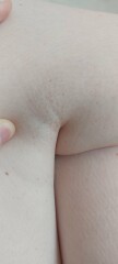 Petechiae and 12 weeks pregnant (rash back of knee)