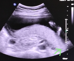 Nub theory: boy or girl?