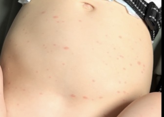 Worried my 1yo has meningitis