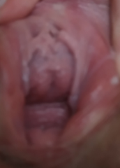 Help, mass under urethra after childbirth