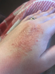 Any idea what this is on my hand? (Photo)