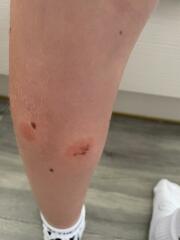 Please help keep identify these bites
