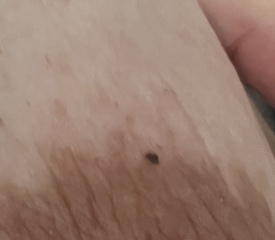 Black spot/ mole on my nipples, help! Pregnant