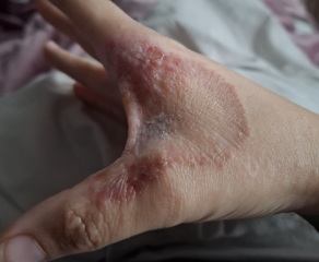 Hand infected (Warning, gross photos)