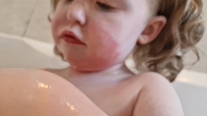 Allergies? Or just skin irritation?