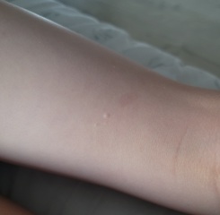 Please help identify these spots/bites