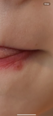 Cold sore?