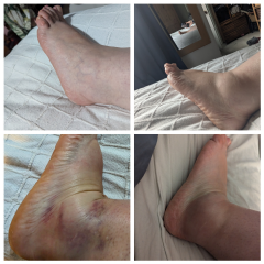 Sprained ankle still swollen after 10 days