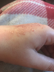 Any idea what this is on my hand? (Photo)