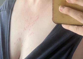 What’s this rash?