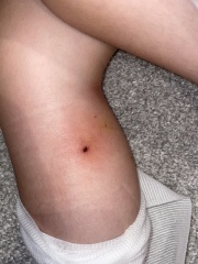 Is this cat bite infected??