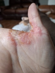 Hand infected (Warning, gross photos)