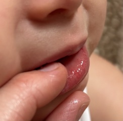 Unusual red rash on inner baby lip