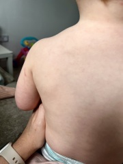 Petechiae on toddler? Photos attached
