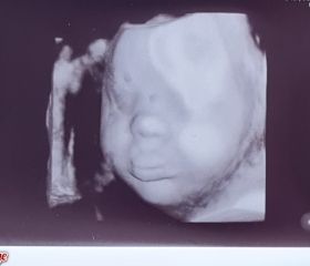 Help has baby got down syndrome?