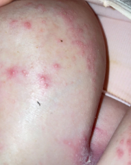 Spotty looking rash between breasts