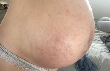 PUPPP pregnancy rash