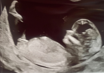 Did anyone have a boy nub on their 12 week scan but end up having a girl?