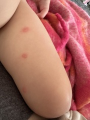 Bites - double bites in same spots???