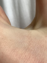 Would you worry about this mole? ☹️ Tired, anxious and fed up