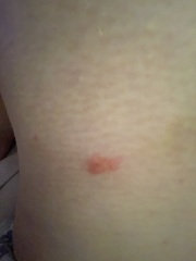 Please help me identify bites!