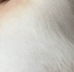 Breast dimpling or stretch marks???