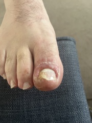 Manky toe