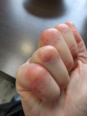Help pls, possible autoimmune