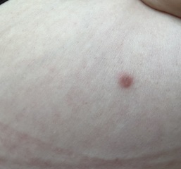 Spot of my breast