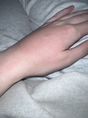 Wasp sting - swollen & painful again weeks later