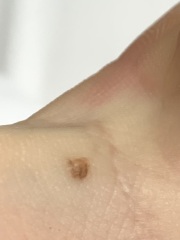Would you worry about this mole? ☹️ Tired, anxious and fed up
