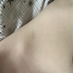 Am I right to be worried about these bruises on my toddler?