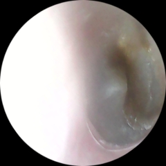 Normal eardrum?