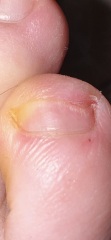 Is this fungus returning? Warning photos
