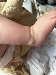 Could this be a peanut allergy?!