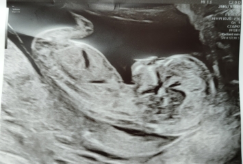Gender guesses? 12 week scan (for fun)