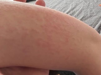 Slapped cheek or scarlet fever?