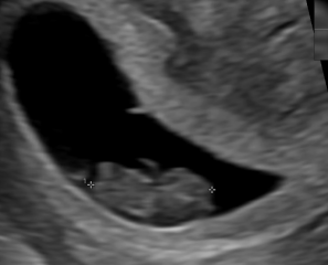 Concerned! Weird shaped gestational sac at first ultrasound
