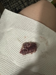*GRAPHIC* i had a miscarriage at 7 weeks and i dont know what this is