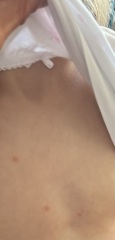 Advice Needed - Chickenpox or not?