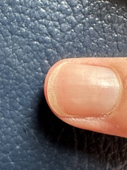 Start of a fungal nail infection?