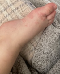 Toddler painful / peeling toes??