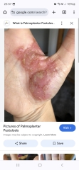 Hand infected (Warning, gross photos)