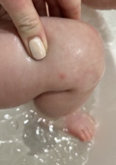 Toddlers skin spots