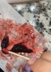 Blood clot or miscarriage? **MNHQ graphic pic warning**