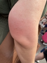 Worried about mosquito bite