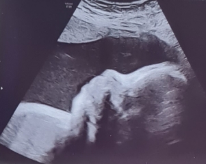 Help has baby got down syndrome?